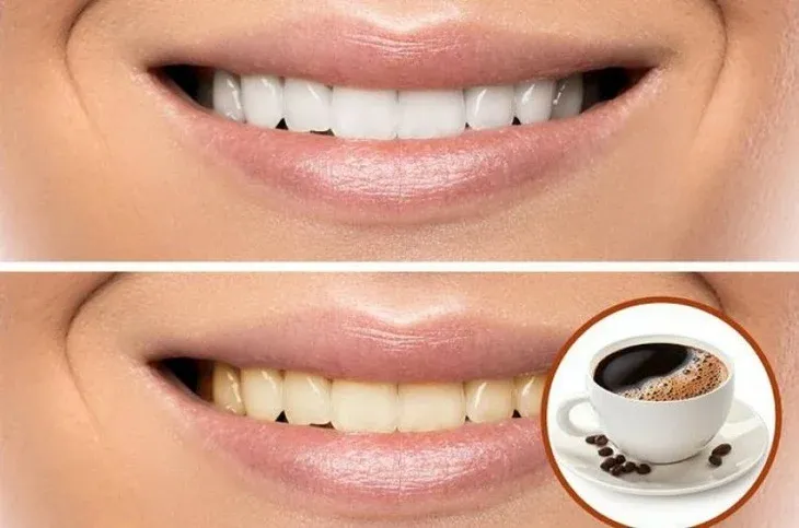 Cà phê chứa tanin có thể gây xỉn màu răng và ảnh hưởng đến vết thương sau nhổ răng khôn