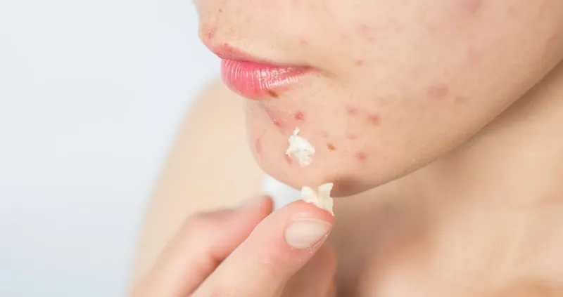 Sử dụng kem trị mụn chuyên dụng lên vùng da bị mụn giúp giảm viêm và làm khô cồi nhanh chóng