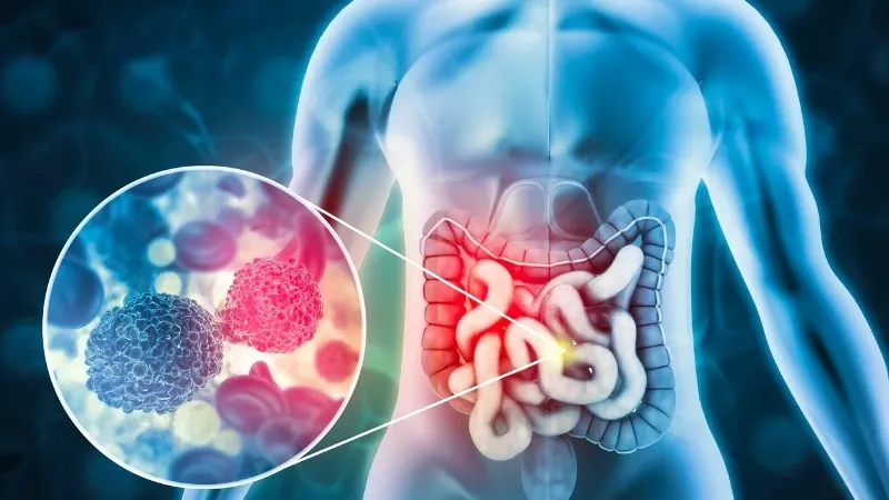 Cà phê hỗ trợ ngăn ngừa ung thư đại trực tràng